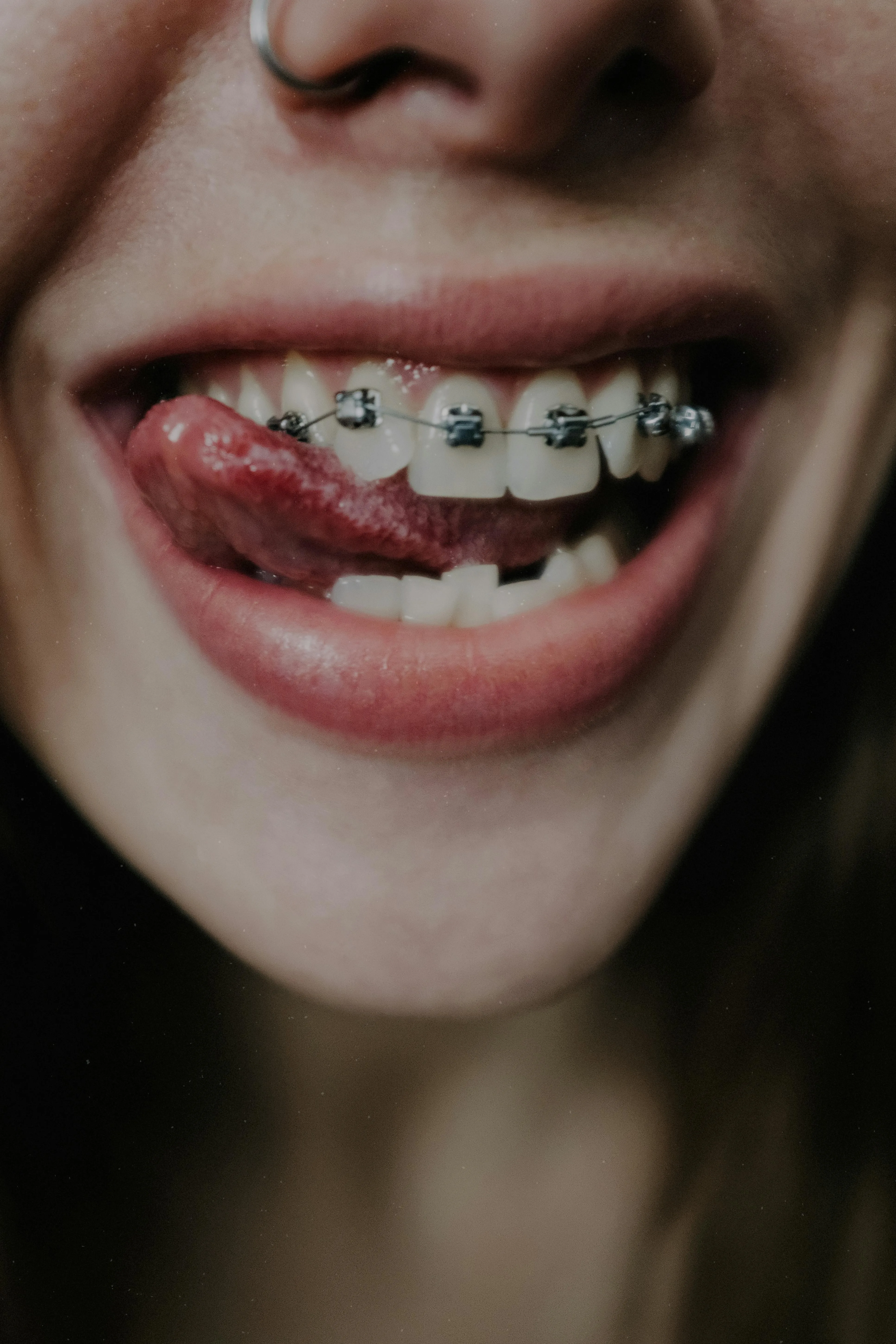 Braces and Tooth Alignment